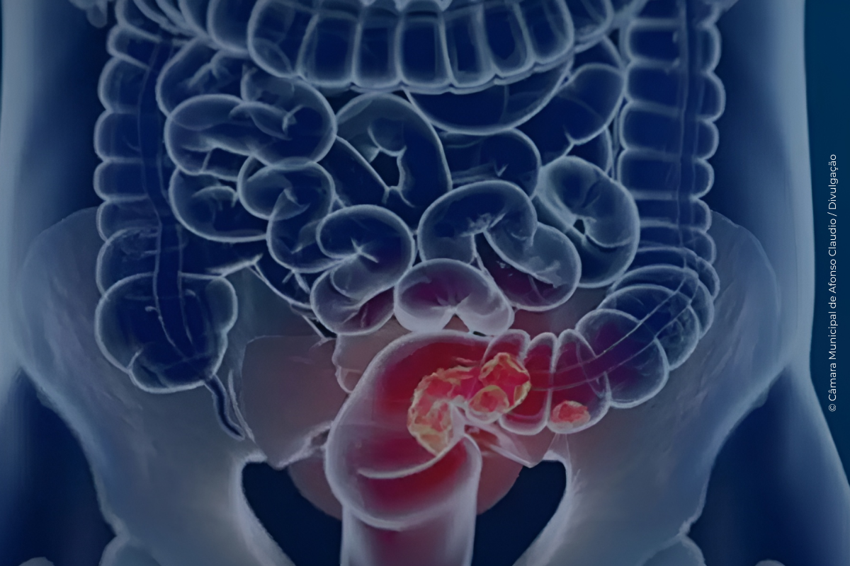 Pacientes com câncer colorretal são diagnosticados em estágio avançado