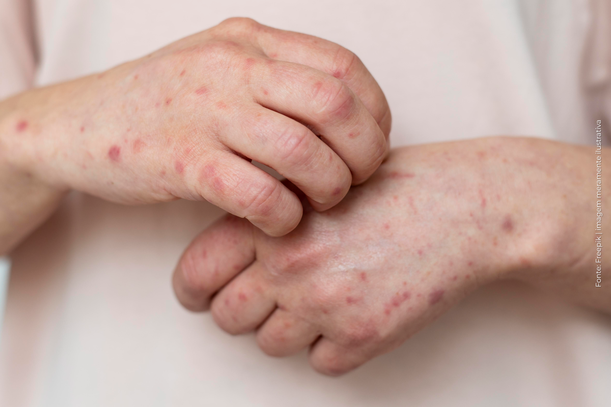 Brasil registra 88 casos de Mpox em 2026; saiba como evitar a doença