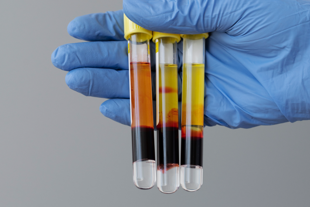 CFM regulamenta uso de plasma rico em plaquetas para tratamento de condições osteomusculares específicas