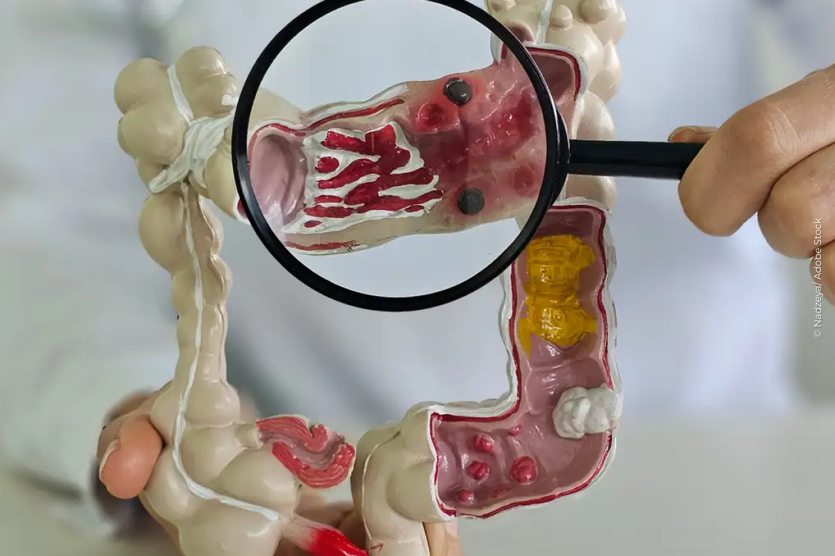 Em 13 anos, doença inflamatória intestinal cresce 5 vezes no Brasil Em 13 anos, doença inflamatória intestinal cresce 5 vezes no Brasil