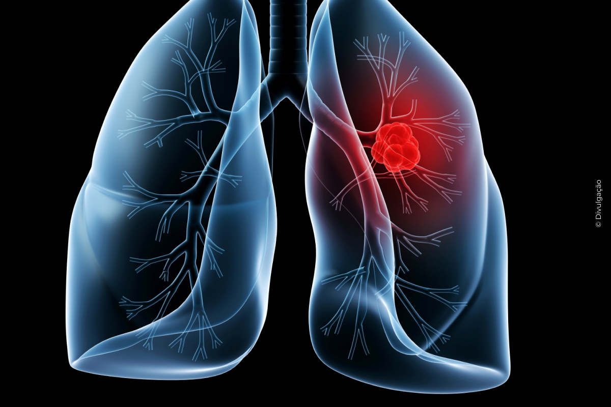 Saiba o que é adenocarcinoma pulmonar, câncer que atinge o papa